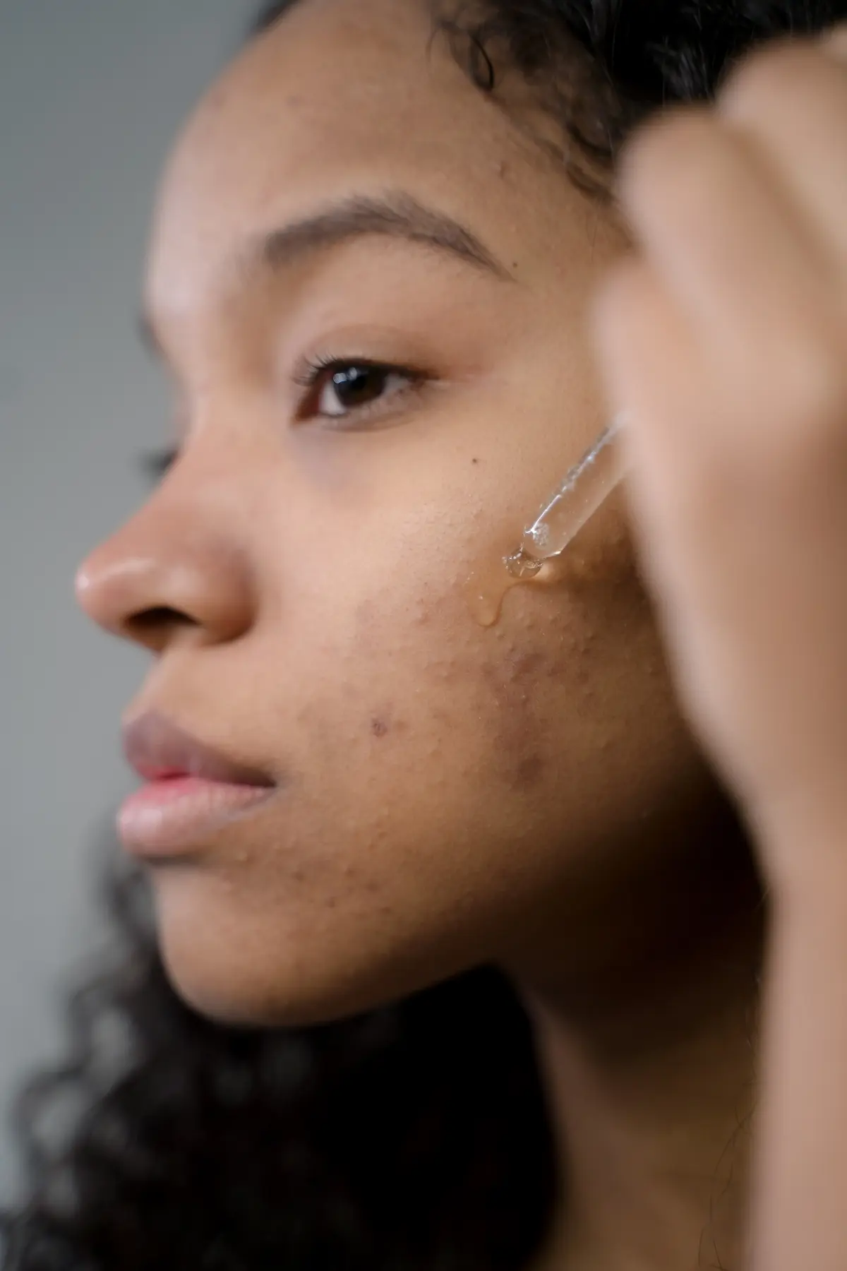how to get rid of acne scars on face products
