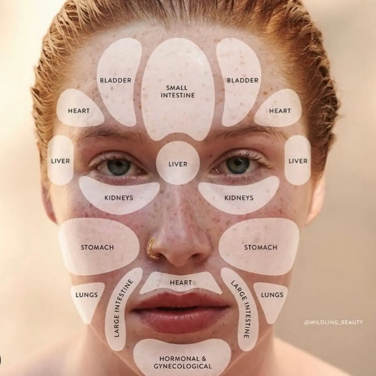 location of acne on face meaning