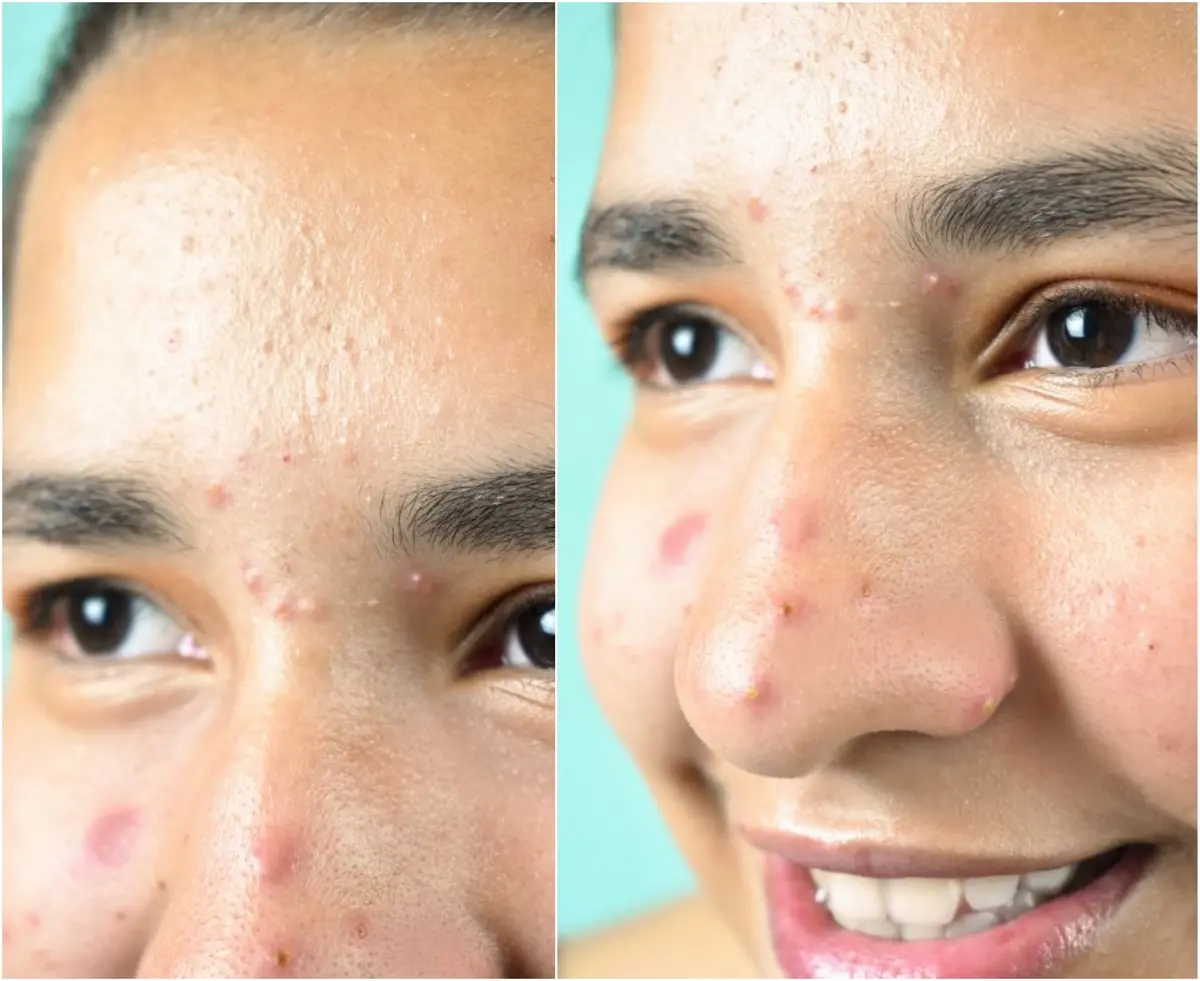 what acne on nose and between eyes means