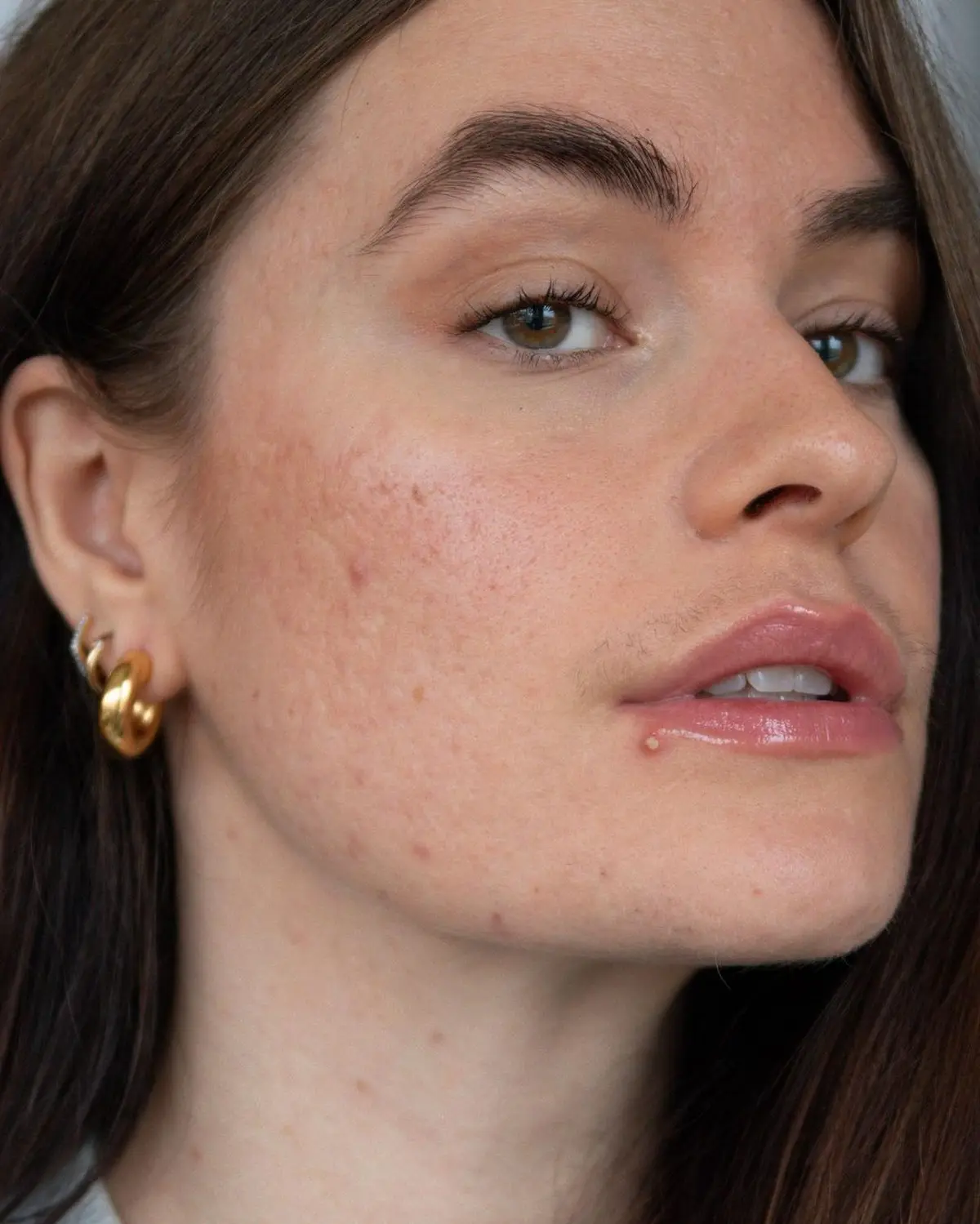 what does it mean if you have acne on the side of your face