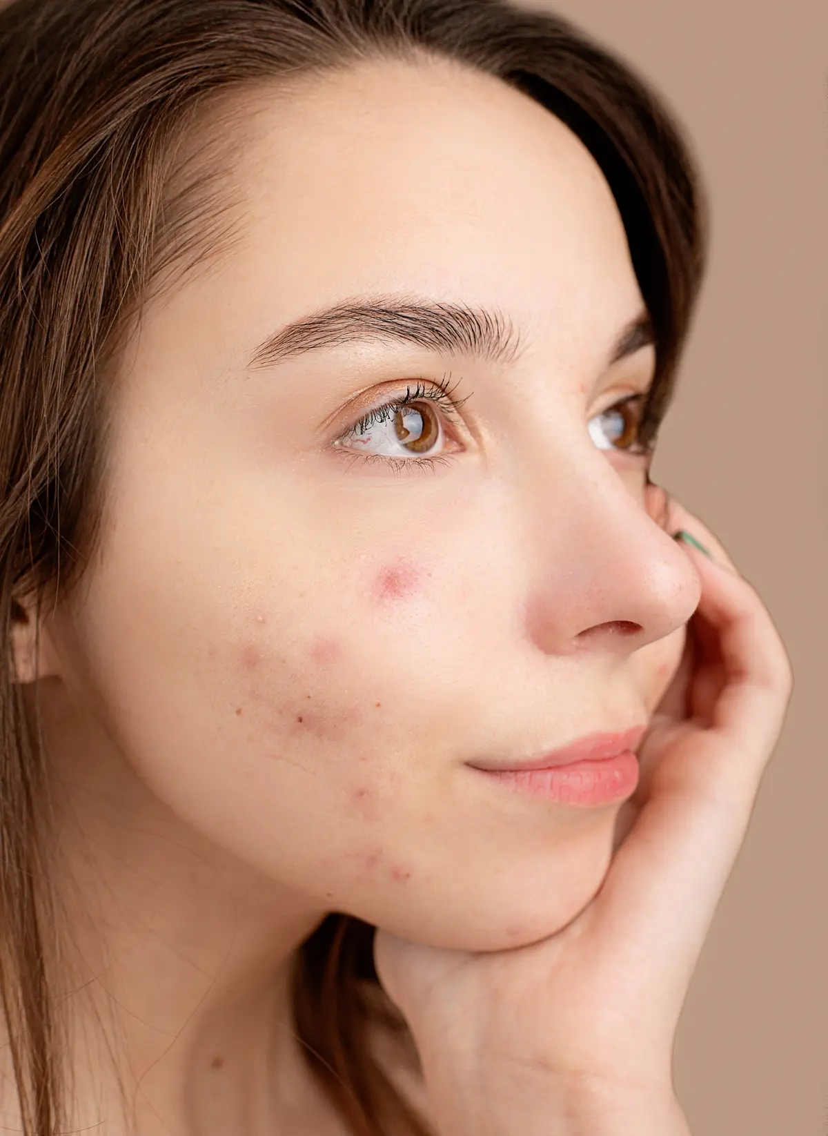 what does it mean when acne on cheeks