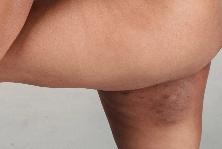 what do dark chafing inner thigh marks look like